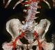 EVAR-graft